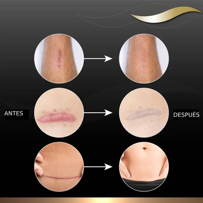 Gel de silicone Dermatix pour le traitement des cicatrices, 15g